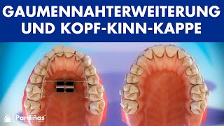 Kieferorthopädie - Gaumennahterweiterung und Kopf-Kinn-Kappe ©