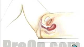 Dilation and Curettage D and C, Patient Education