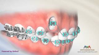 Impacted Canine Exposure by Laser - Orthodontic Treatment