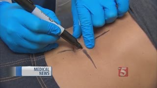 Doctor Discusses Turning An Outie Belly Button Into An Innie