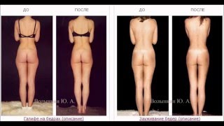 Как убрать галифе? Как убрать ушки на бедрах? Ручная Пластика - коррекция фигуры.