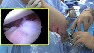Arthroscopic Labral Repair of the shoulder- Dr Patrick Jost