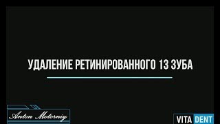 Удаление ретинированного 13 зуба