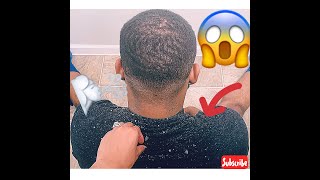 Irritated Dry Scalp| Comb Out| Dandruff Removal| Satisfying Scalp Scratch