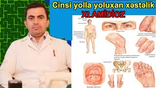 Cinsi yolla yoluxan xesteliklerin yaratdigi fesadlar