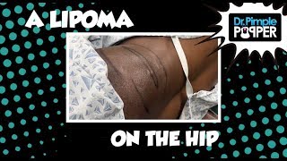 A Grammy Winning Lipoma