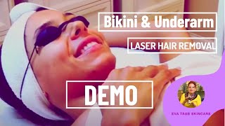 Bikini & Underarm Laser Hair Removal Demo (What to Avoid)