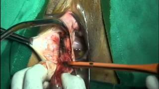 Bartholin cyst excision