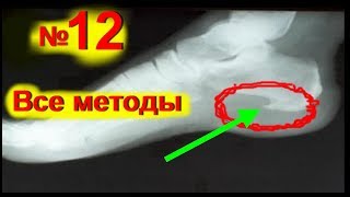 Пяточная шпора лечение в домашних условиях! Как лечить шпору- боль в пятке - № 12 |#пяточнаяшпора