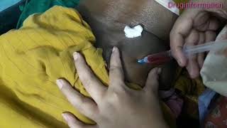 Buttock injection push woman [Druginformation ]