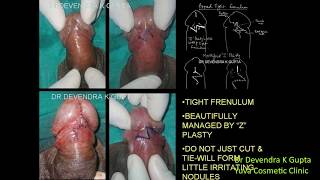 Tight Frenulum Frenuloplasty