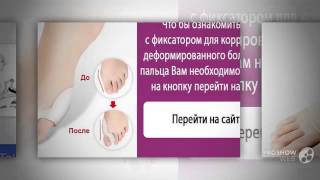 проблема косточки на ногах

  - Valgus Pro - Обзор Фиксатора