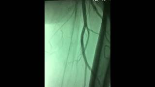 Dr ersan tatlı bacak damarı tıkanıklığı periferik Stent per