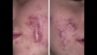 ДАВИМ ГЛУБОКИЕ ЧЕРНЫХ ТОЧКИ НА ЛИЦЕ / ПРЫЩИ-УГРИ НА ЛИЦЕ