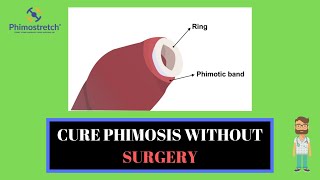 Cure phimosis and solve tight foreskin without Circumcision - Phimostretch (An introduction)