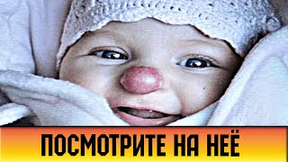 Как спустя 3 года выглядит девочка, которая родилась с «клоунским» носом