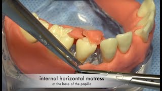 Periodontal Regenerative Emdogain Surgery with Papilla preservation - Flap design and suturing