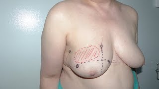 Extreme Oncoplasty following neoadjuvant chemotherapy