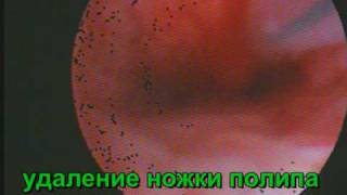Ножка полипа шейки матки. Радикальное удаление