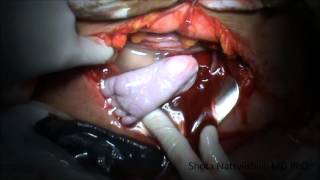Caesarean section - footling breech and shoulder presentation
