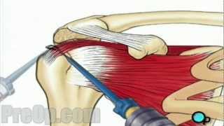 Rotator Cuff Repair Arthroscopic Surgery PreOp Patient Education