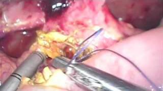 Laparoscopic pancreaticoduodenectomy (2/2)