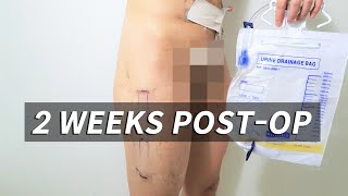 [FTM] Phalloplasty: 2 Weeks Post-op Stage 1