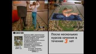 Лечение ДЦП: до и после. Катя