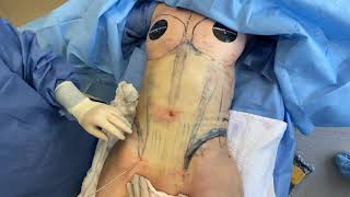 Female Body Contouring | Power-Assisted Liposuction to Torso | West Hollywood, CA | Dr. Jason Emer
