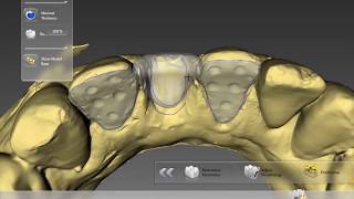 Digital Maryland bridge - Inlab Dentsply Sirona CAD CAM