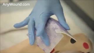 Enluxtra Humifiber Self-Adaptive Wound Dressing - Application on Full Thickness Heel Wound
