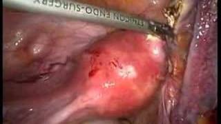 Podcast: See Novel Gynecologic Oncology Procedures Using...