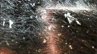 A QUICK SCRATCH | Dandruff Flakes Psoriasis Scratching Picking Combing HUGE SCALES