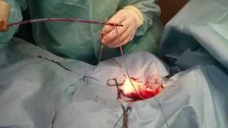 Heart worms removal In Israel