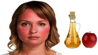 The Best Way to Get Rid of Redness on Your Face Using Apple Cider Vinegar