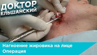 Нагноение жировика на лице операция