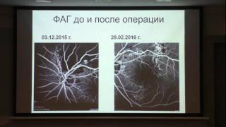 Микроинвазивная витрэктомия в лечении геморрагической формы ретинальной артериальной макроаневризмы