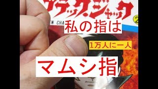 私の指は「マムシ指（短指症）」1万人に1人
