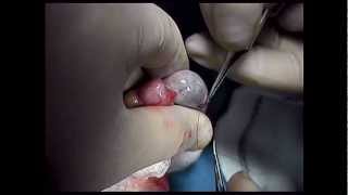 Microsurgical Testicular Sperm Extraction, Dr. Ethan Grober