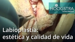 Labioplastía: estética y calidad de vida (18202)