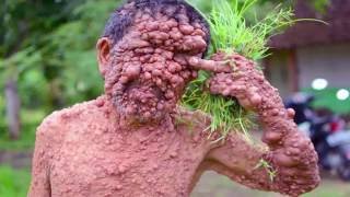 Những Căn Bệnh Kỳ Lạ ,Kinh Dị Và Khó Chữa Nhất Thế Giới