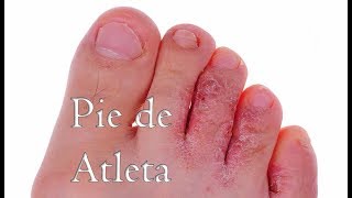 Como eliminar el pie de atleta con la ayuda de tres ingredientes que puedes encontrar en casa