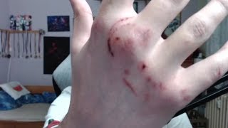Opat04 má zlomenou ruku + Další perma ban na Lolku