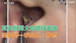 耳朵粉刺大如地球表面 美容師一手挖出：療癒｜三立新聞網SETN.com
