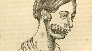 ფეთქებადი კბილი. 19 საუკუნის ფენომენი, რომლის ახსნაც დღემდე ვერ შეძლეს