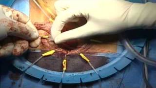 Live-Op-Vordere vaginale Rekonstruktion, Elevate -- G. Schön