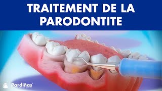 Curetage et détartrage - Traitement de la parodontite ©