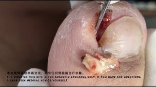 甲溝炎-paronychia 베트남/realxing video 132/涷甲/嵌甲/Ingrown nail treatment（how to fix ingrown toenail）