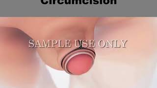 Penis outer layer Removal || Circumcision