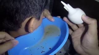Hard & Massive Earwax Removal by Ear Irrigation